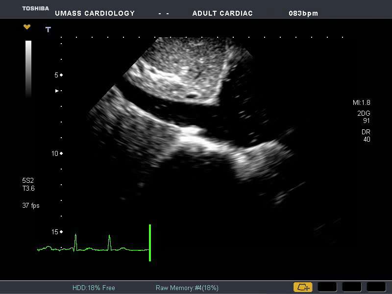 Focused cardiac ultrasound and diagnosis of Cardiovascular complications associated with Coronavirus (COVID-19) 